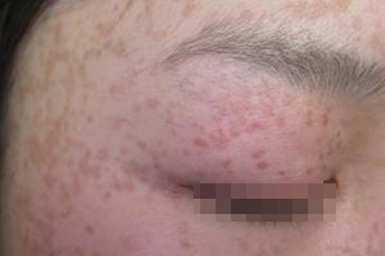 扁平疣颞部密布褐色小斑点图