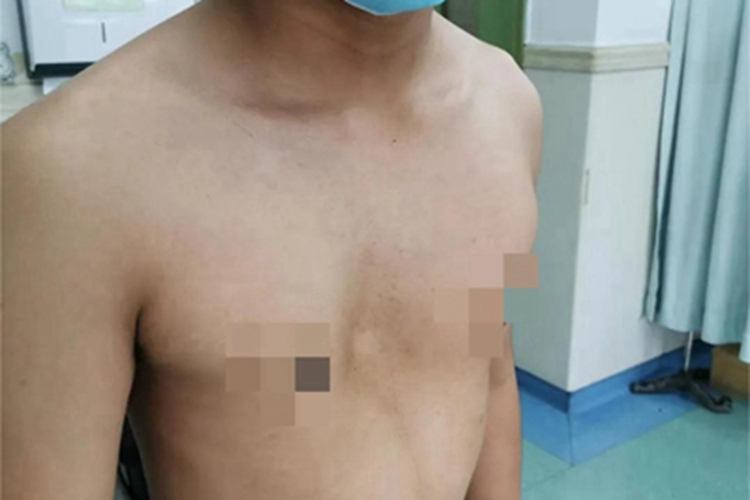 漏斗胸胸部症状图