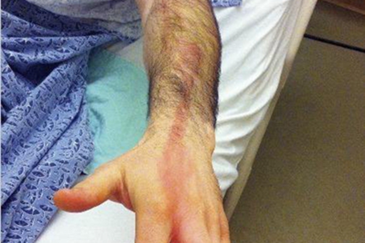 急性淋巴管炎手背条纹图