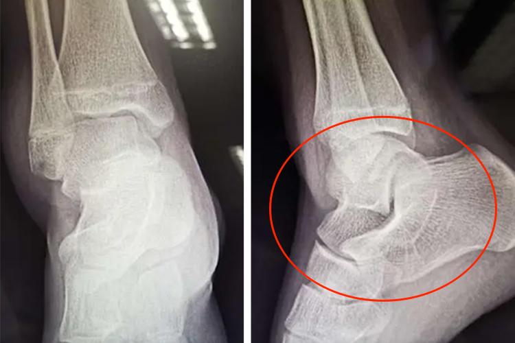 脚踝三角韧带损伤X光图