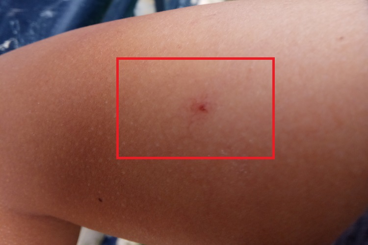 蜘蛛痣胳膊症状图