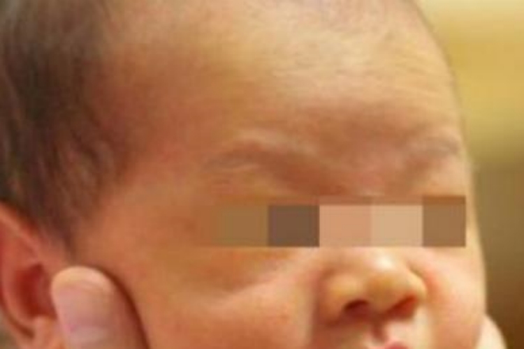 α地中海贫血黄疸图