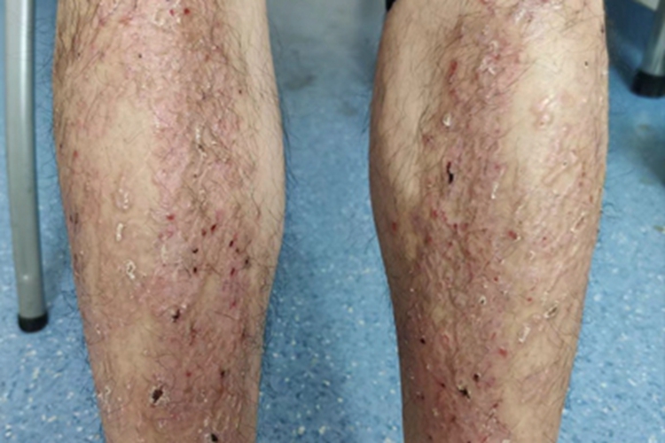 毛发扁平苔藓结痂图 毛发扁平苔藓结痂图