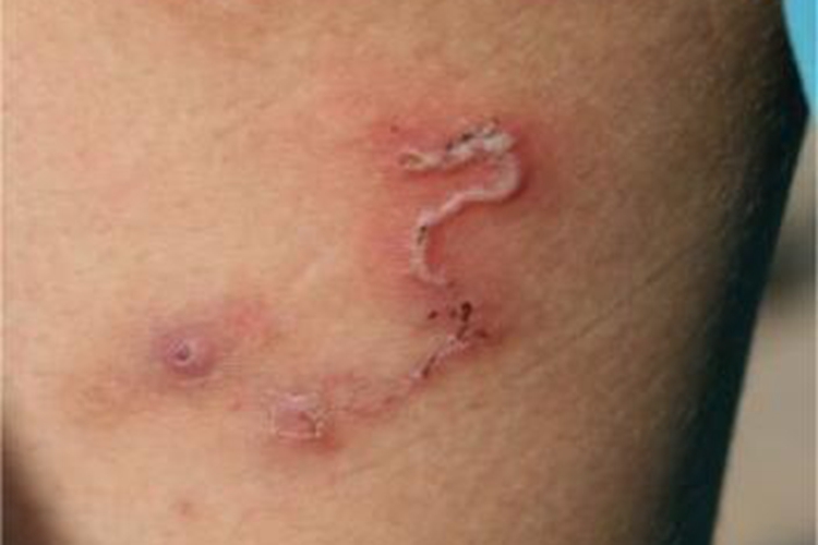 匐行疹大腿症状图 匐行疹大腿症状图