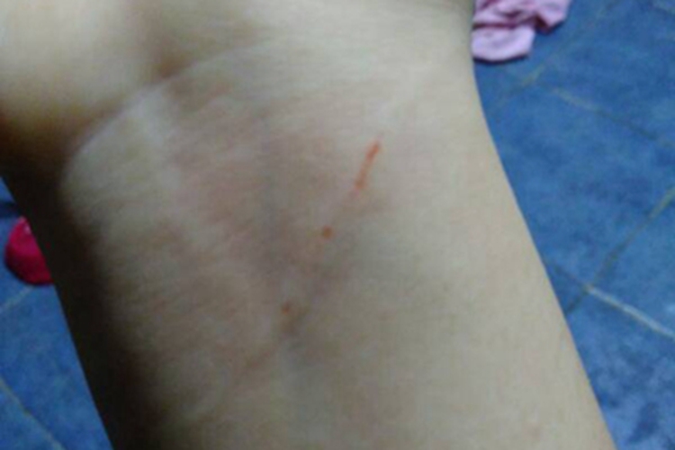 抓伤手腕症状图