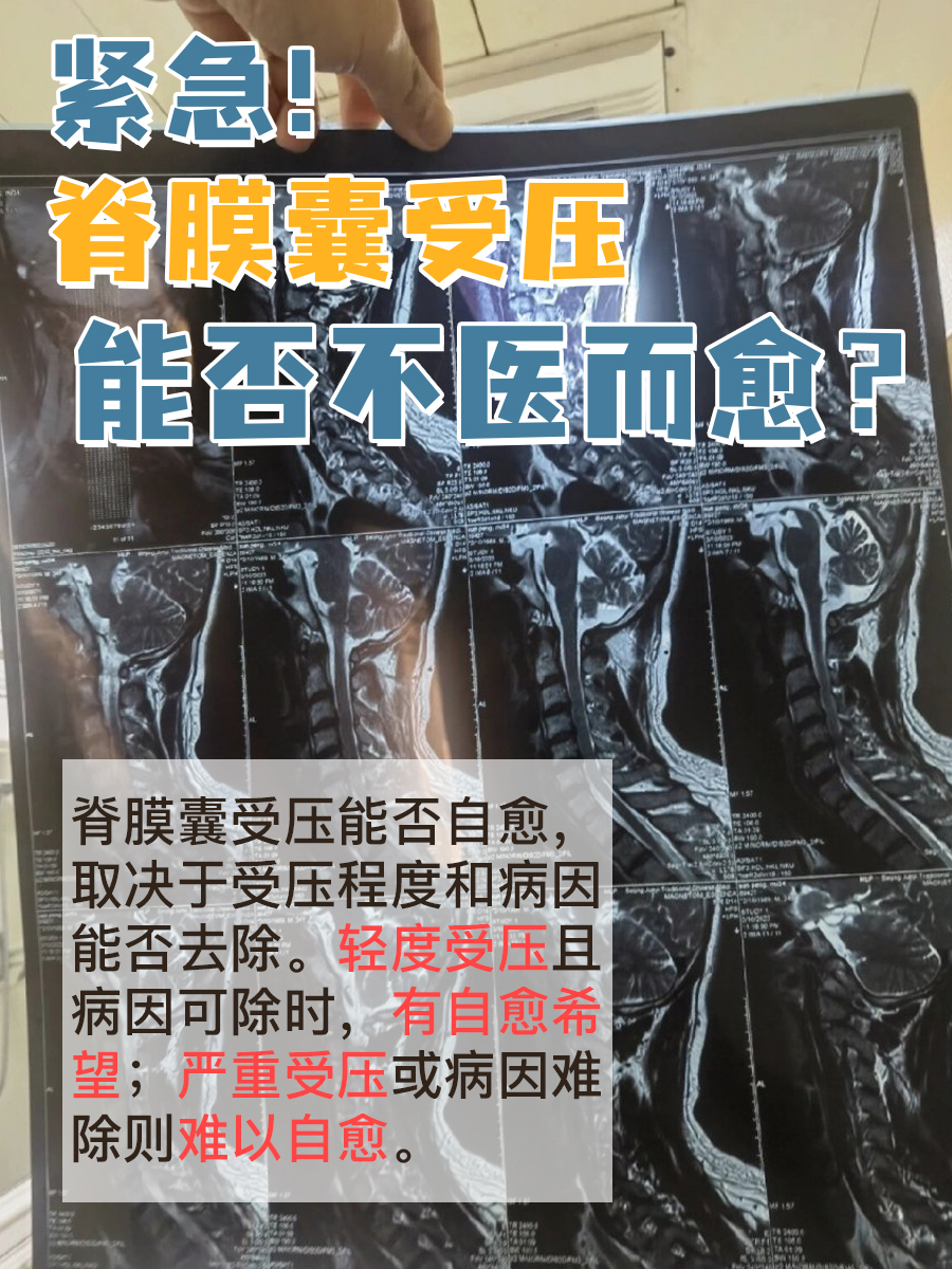 紧急！脊膜囊受压，能否不医而愈？