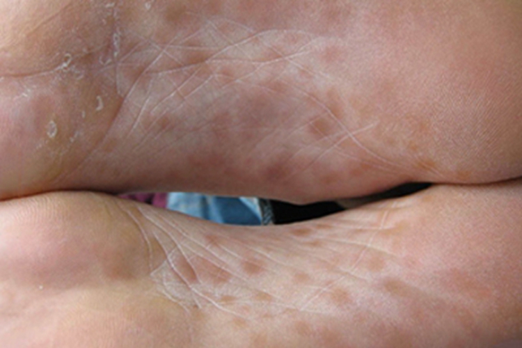 男性二期梅毒脚底症状图