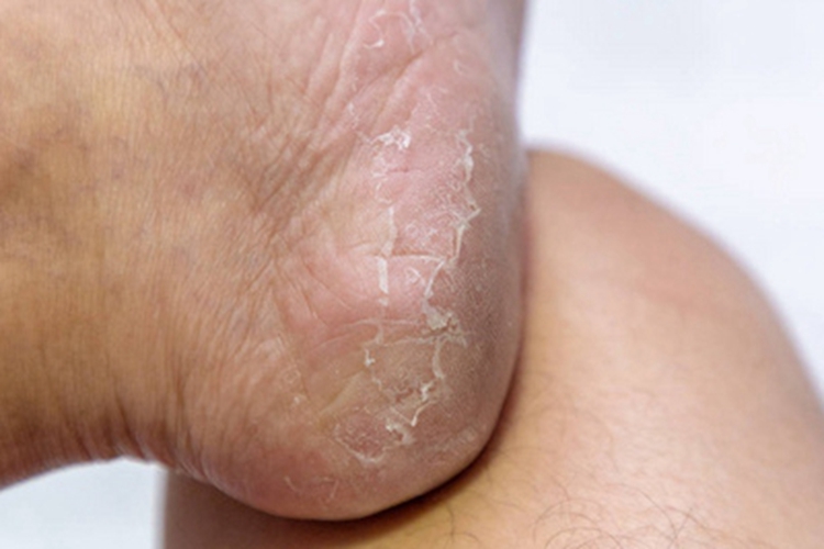 儿童期特应性皮炎脱皮图 儿童期特应性皮炎脱皮图