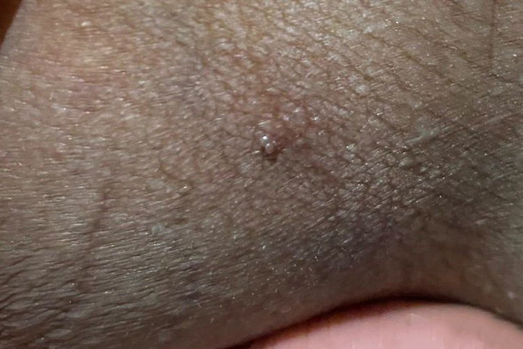 大腿根部皮赘图