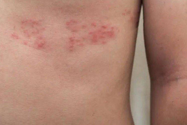 带状疱疹的丘疱疹图