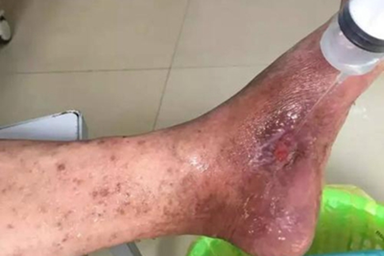 血栓闭塞性脉管炎脚部溃疡图