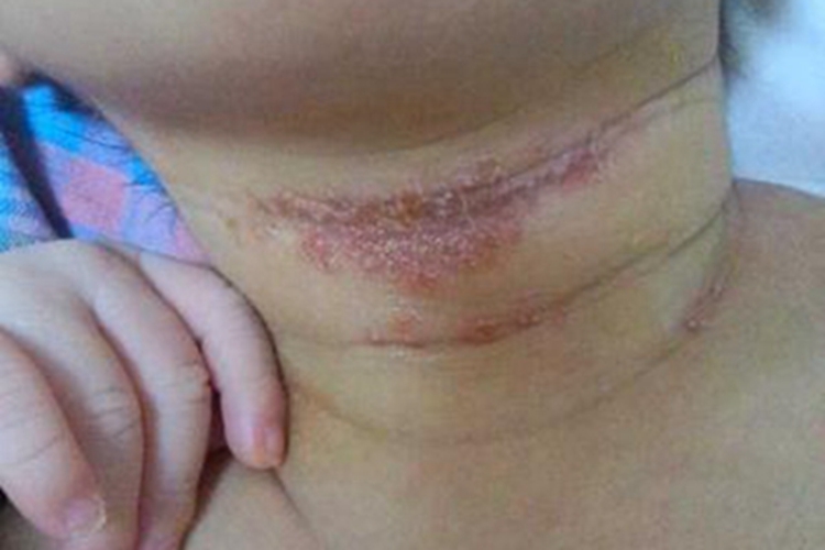 干燥型婴儿湿疹前颈发红图