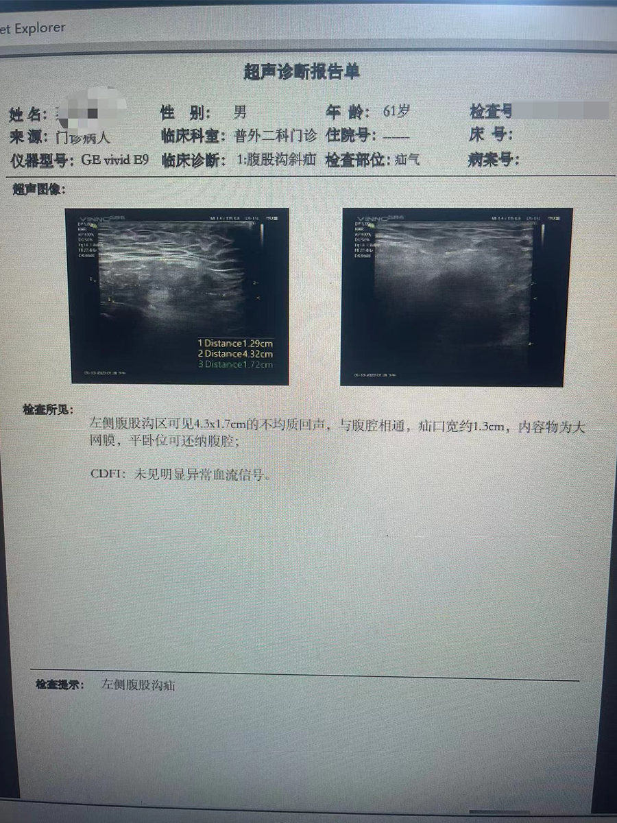 61岁大叔患左侧腹股沟斜疝,手术治疗助其恢复!