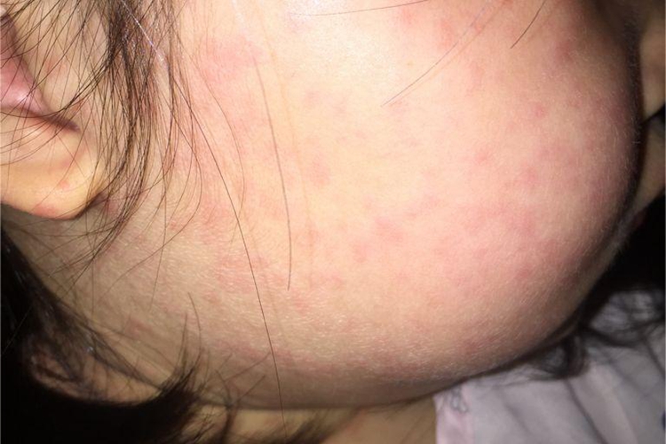 柯萨奇病毒疹面部风团图