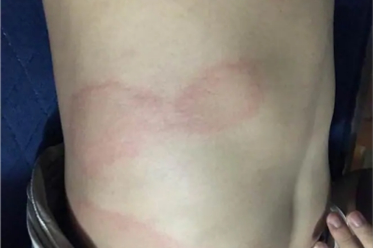 热接触性荨麻疹肋部风团图