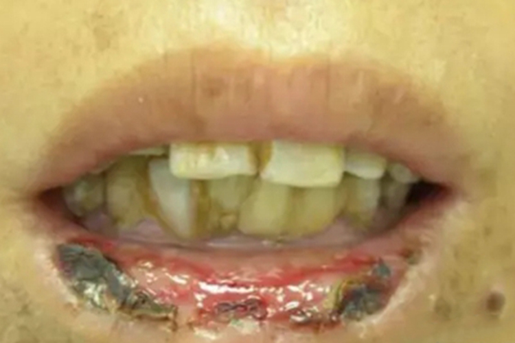 剥脱性唇炎下嘴唇结痂图 剥脱性唇炎下嘴唇结痂图