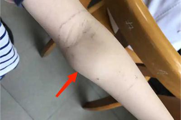 滑膜肉瘤胳膊肿块图 滑膜肉瘤胳膊肿块图