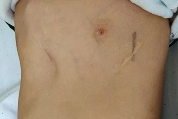 佝偻病串珠愈合后图