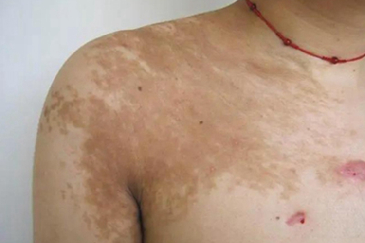 色素性毛表皮痣症状图 色素性毛表皮痣症状图