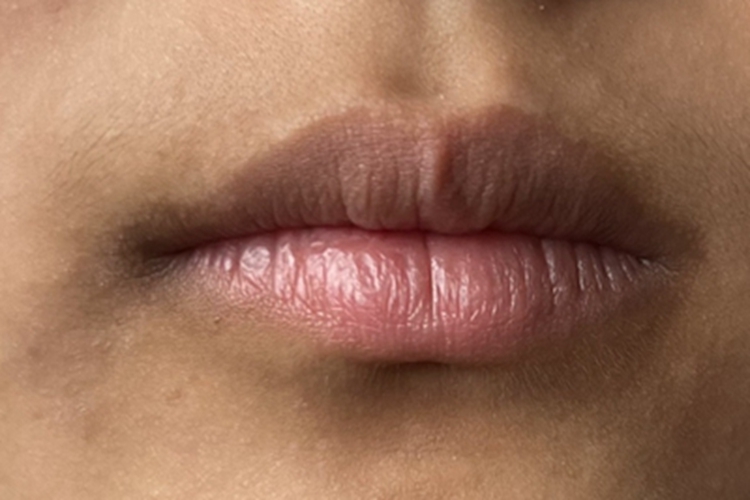 炎症后色素沉着嘴唇皮肤发黑图