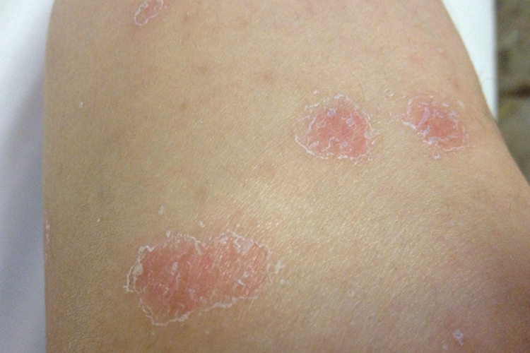 玫瑰糠疹大腿圆圈状红斑图