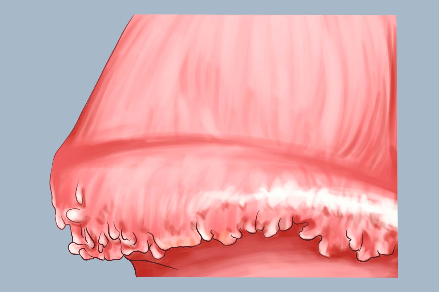 珍珠状阴茎丘疹图 珍珠状阴茎丘疹图