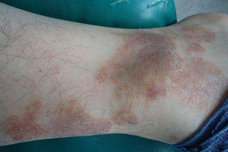 金黄色苔藓症状图