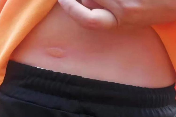 红火蚁咬人后肿图