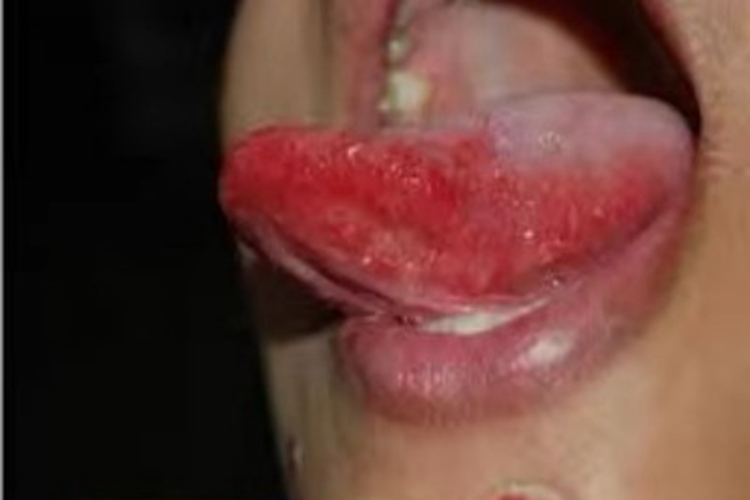 药物过敏性口炎舌头红斑图