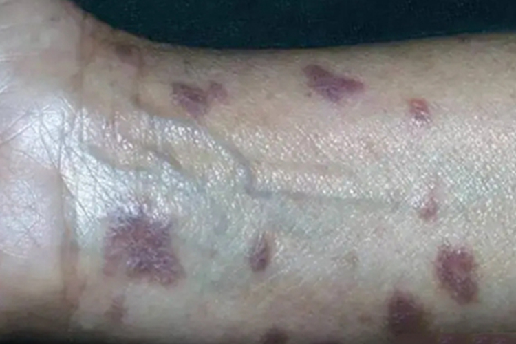 光线性扁平苔藓手腕有紫色斑块图 光线性扁平苔藓手腕有紫色斑块图