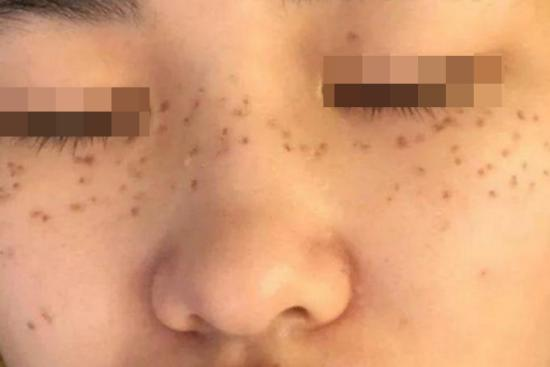 药水点斑局部结痂图 药水点斑局部结痂图