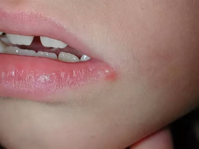 接触性口角炎儿童嘴角水疱图