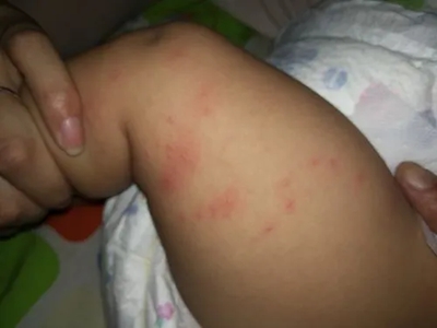 新生儿红斑大腿内侧长红疙瘩图.jpg