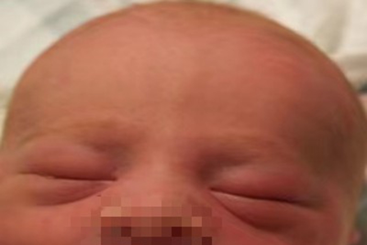 新生儿水肿眼睑肿胀图