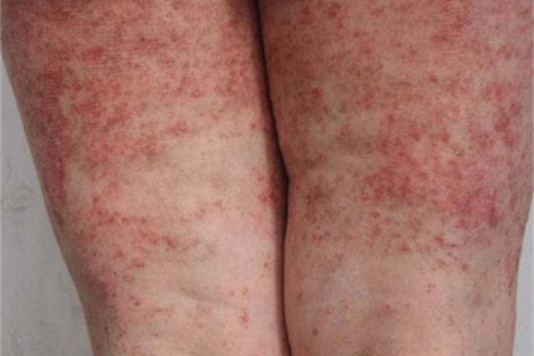 湿疹样紫癜大腿症状图 湿疹样紫癜大腿症状图