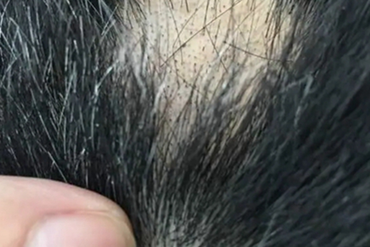 黑点癣头皮上头发变少图