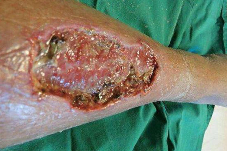 棕蛛中毒所致坏疽图