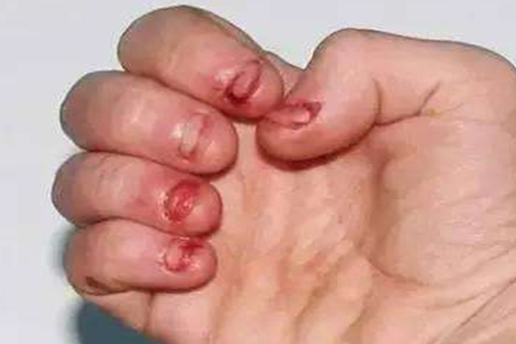 手指损伤指甲缘出血图