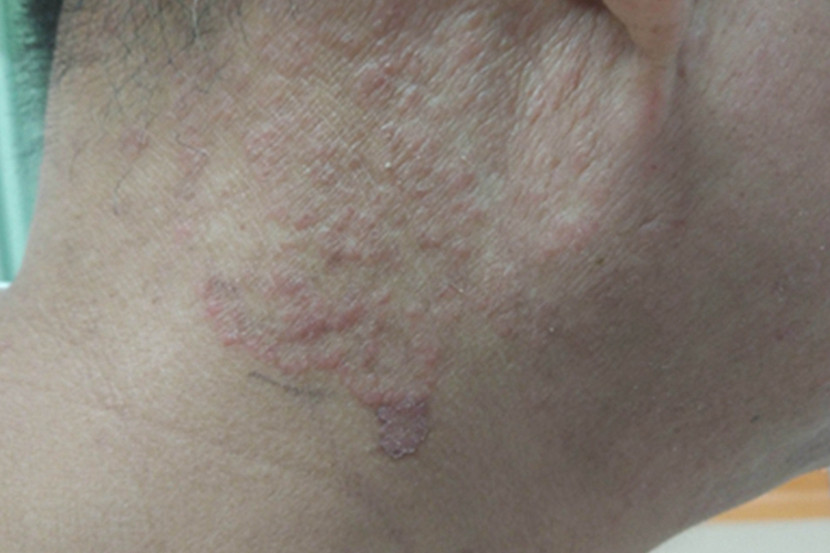 难辨认癣侧颈症状图