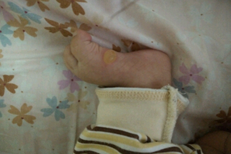 婴儿肢端脓疱病脚部大水疱图