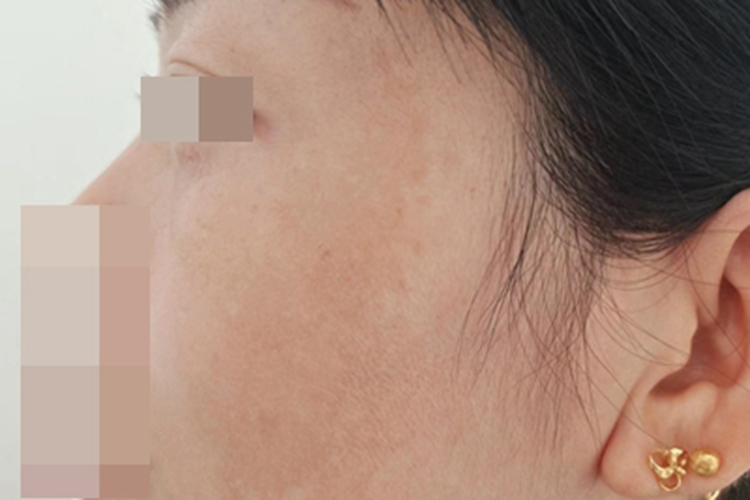 黄褐斑脸上长大片的斑图