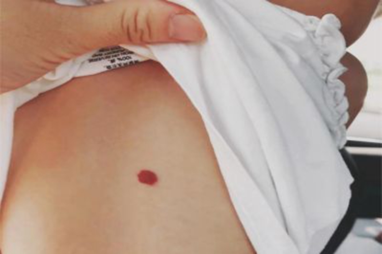 樱桃状血管瘤背部红点图 樱桃状血管瘤背部红点图