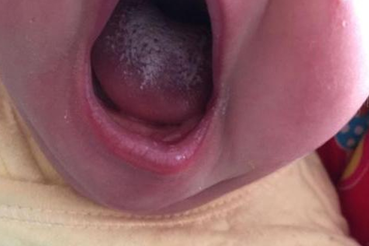 宝宝舌头发紫图 宝宝舌头发紫图