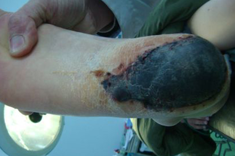 皮肤坏死结黑色硬壳图