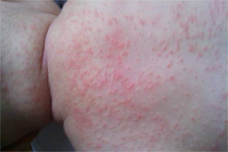 痱子背部红点图 痱子背部红点图