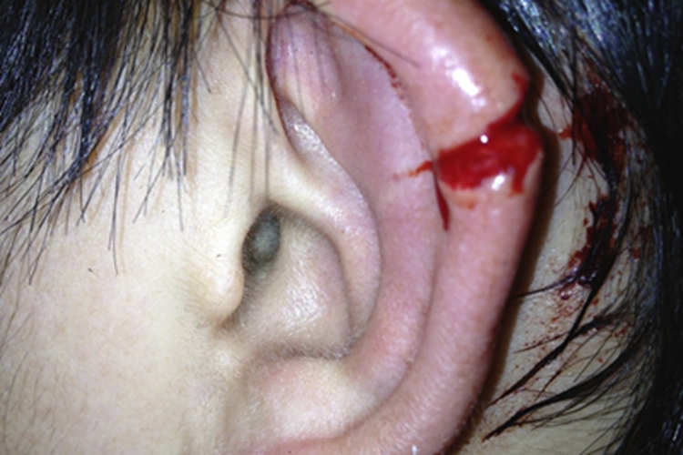 耳廓撕裂伤裂口图
