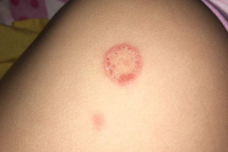 为什么会突然长体癣