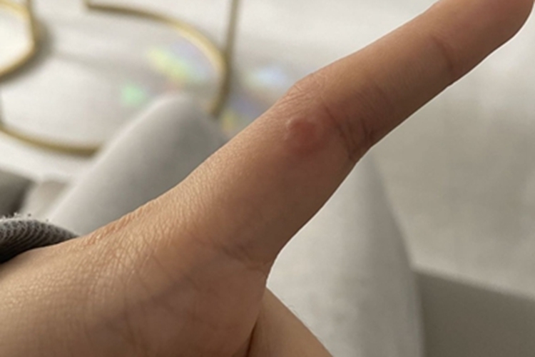 环状肉芽肿手指症状图