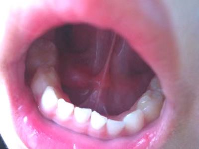 舌下腺囊肿舌头下面右侧有个包图.jpeg