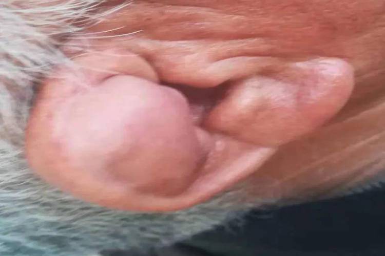 耳朵三角窝皮脂腺囊肿图